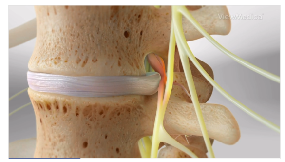 Causes, Symptoms, and Treatments of Spine Fractures