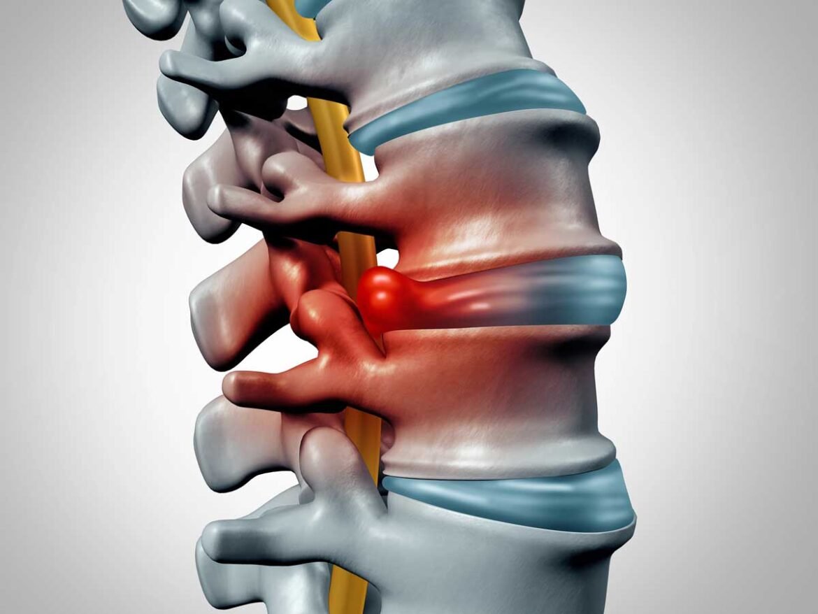 Exploring the Latest Innovations in Disc Surgery