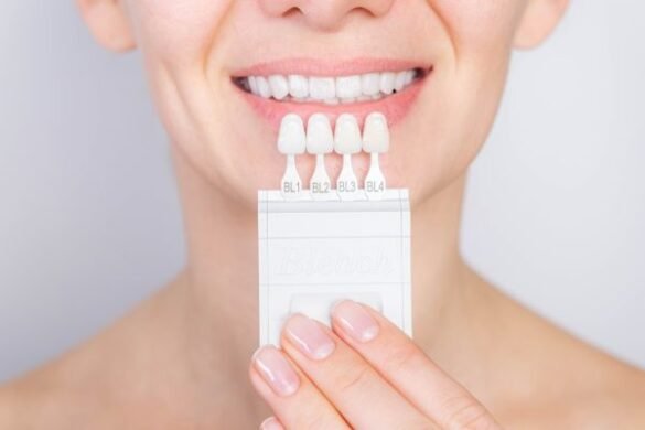 Understanding Risks and Rewards of Veneer Placement