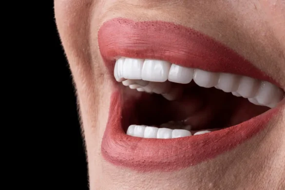 Choosing Porcelain Veneers for a Natural-looking Smile