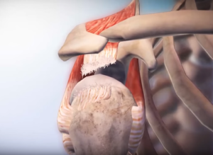How To Manage a Rotator Cuff Tear