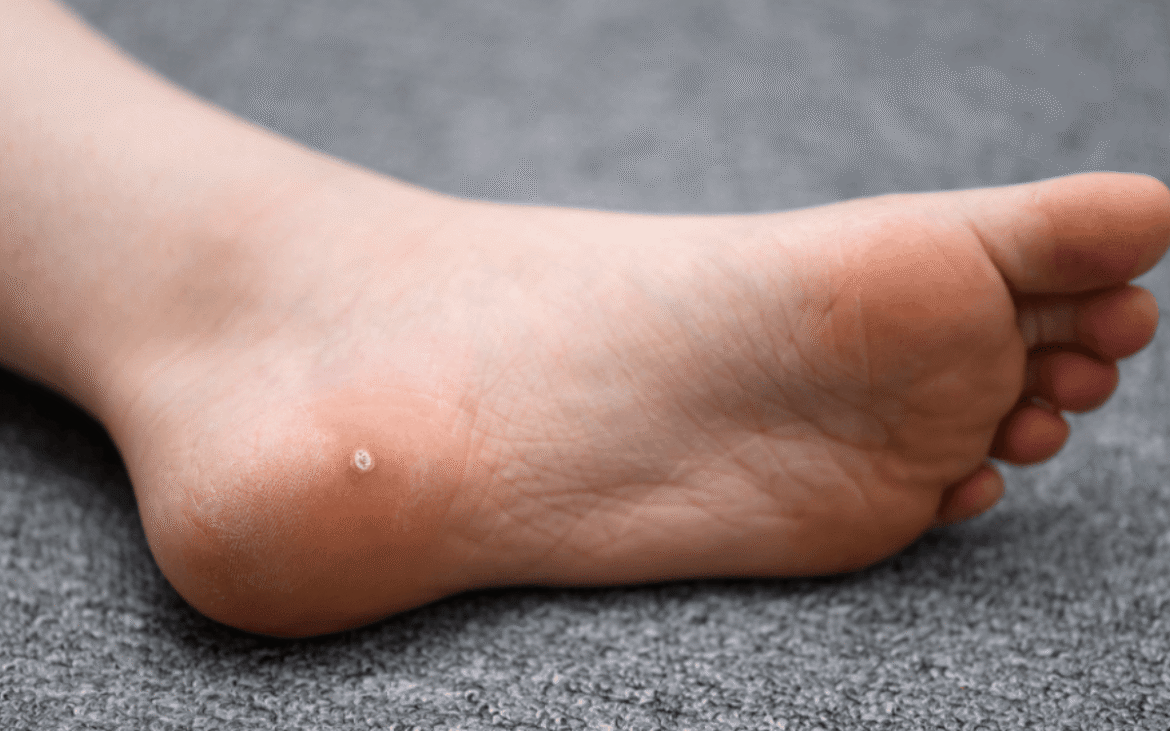 What You Should Know About Treatment Options for Plantar Warts